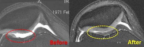 Stem cell orthopedic treatment