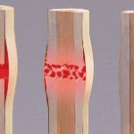 bone-fracture
